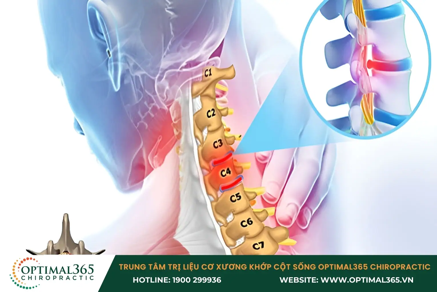 Lồi đĩa đệm cột sống cổ là tình trạng phần nhân nhầy bên trong đĩa đệm bị lồi ra