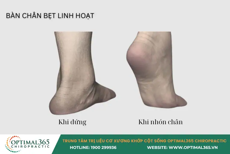 Bàn chân bẹt linh hoạt