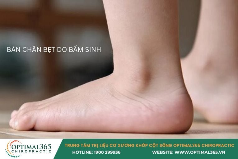 bàn chân bẹt do bẩm sinh