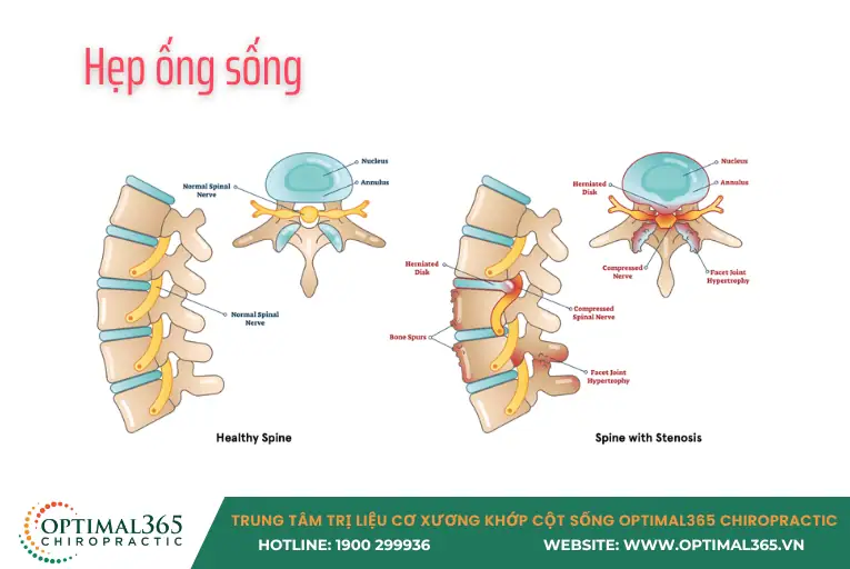 Hẹp ống sống gây đau lưng dưới
