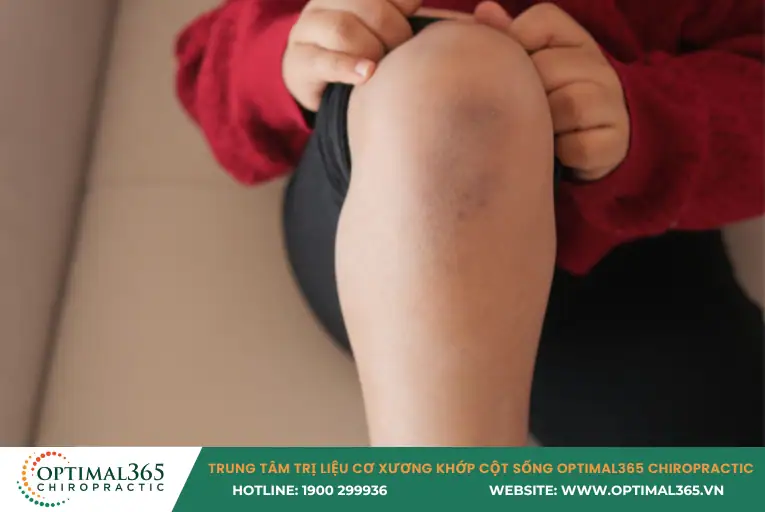 bong gân đầu gối là gì