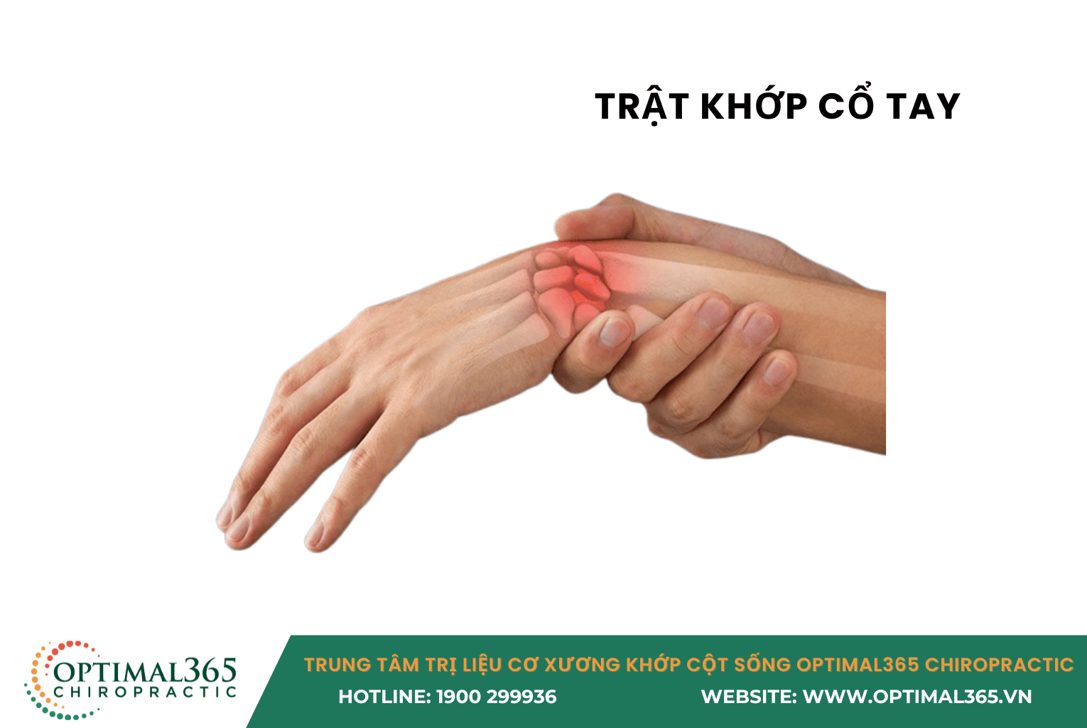 TRẬT KHỚP CỔ TAY