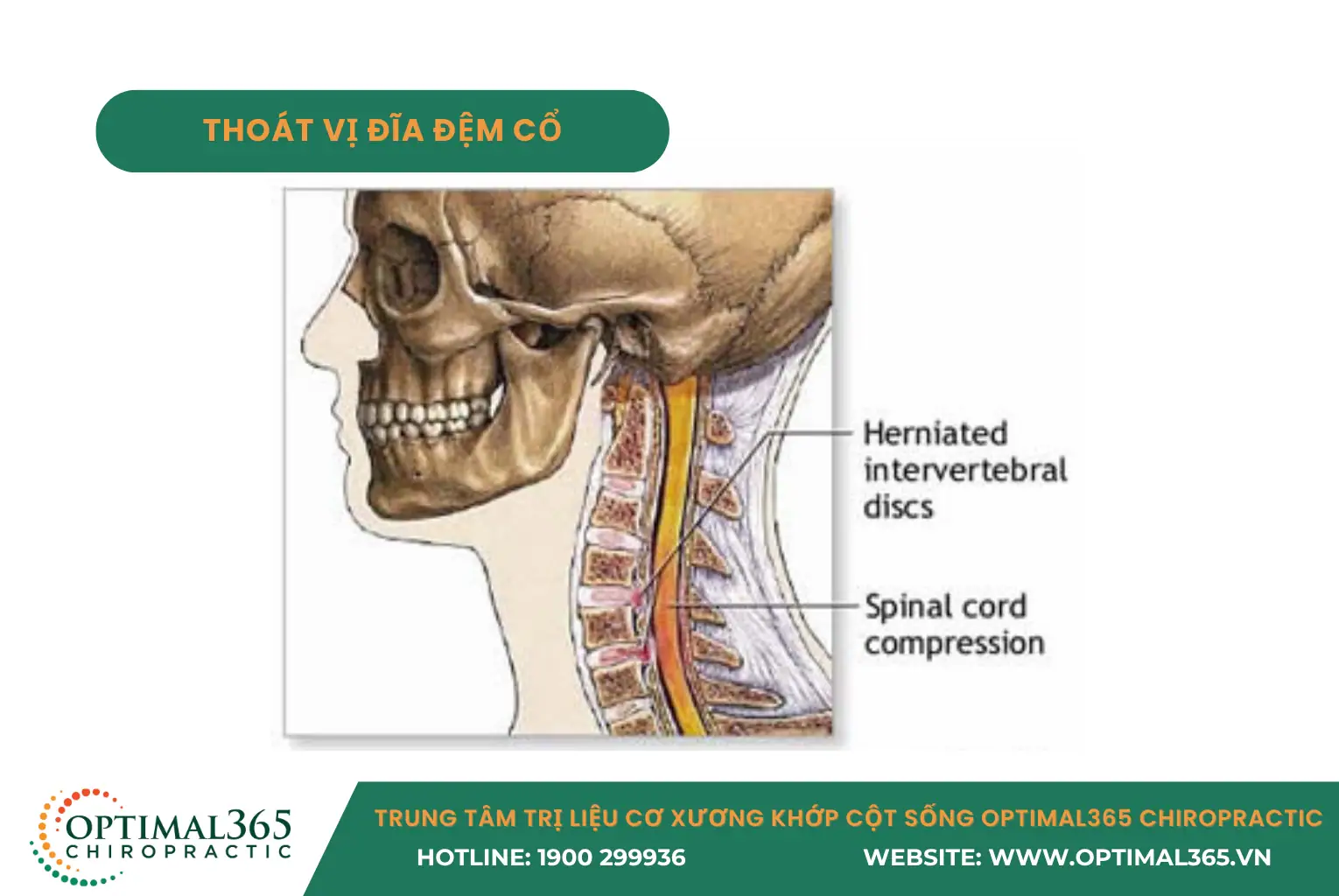 Thoát vị đĩa đệm cổ - bệnh lý gây tê tay khi ngủ