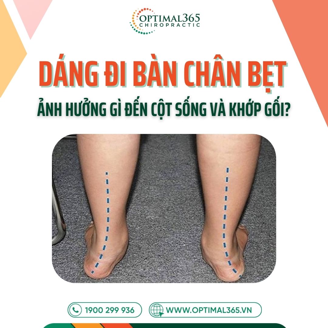 Dáng đi bàn chân bẹt và các vấn đề về cột sống, khớp gối