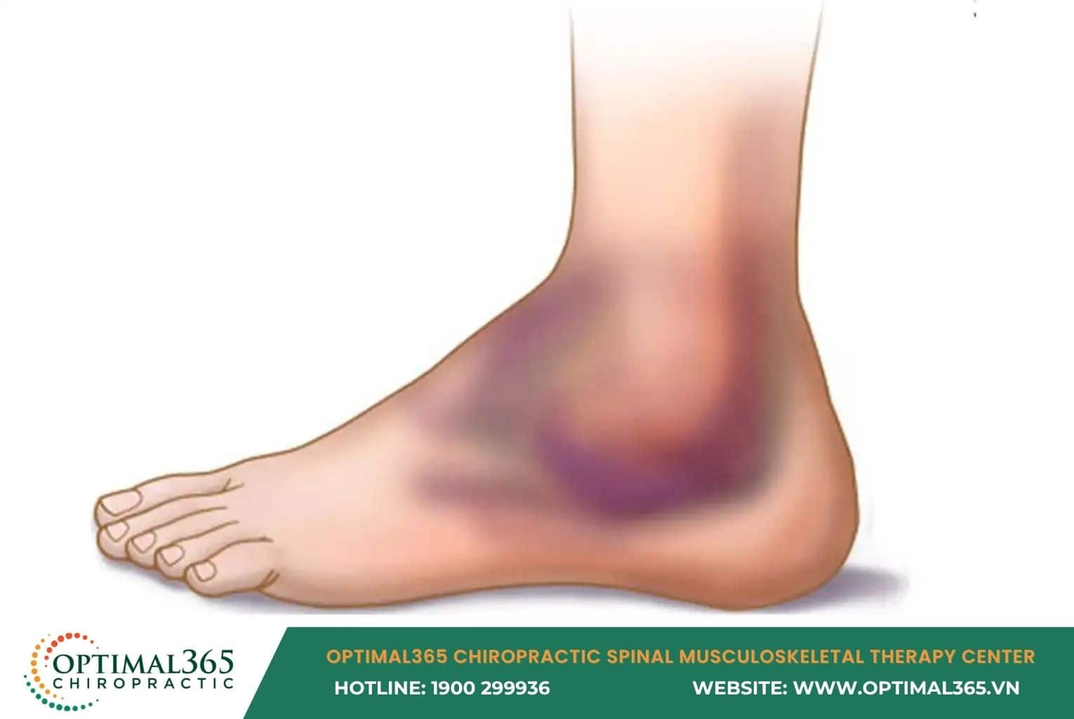 What is an Ankle Sprain?