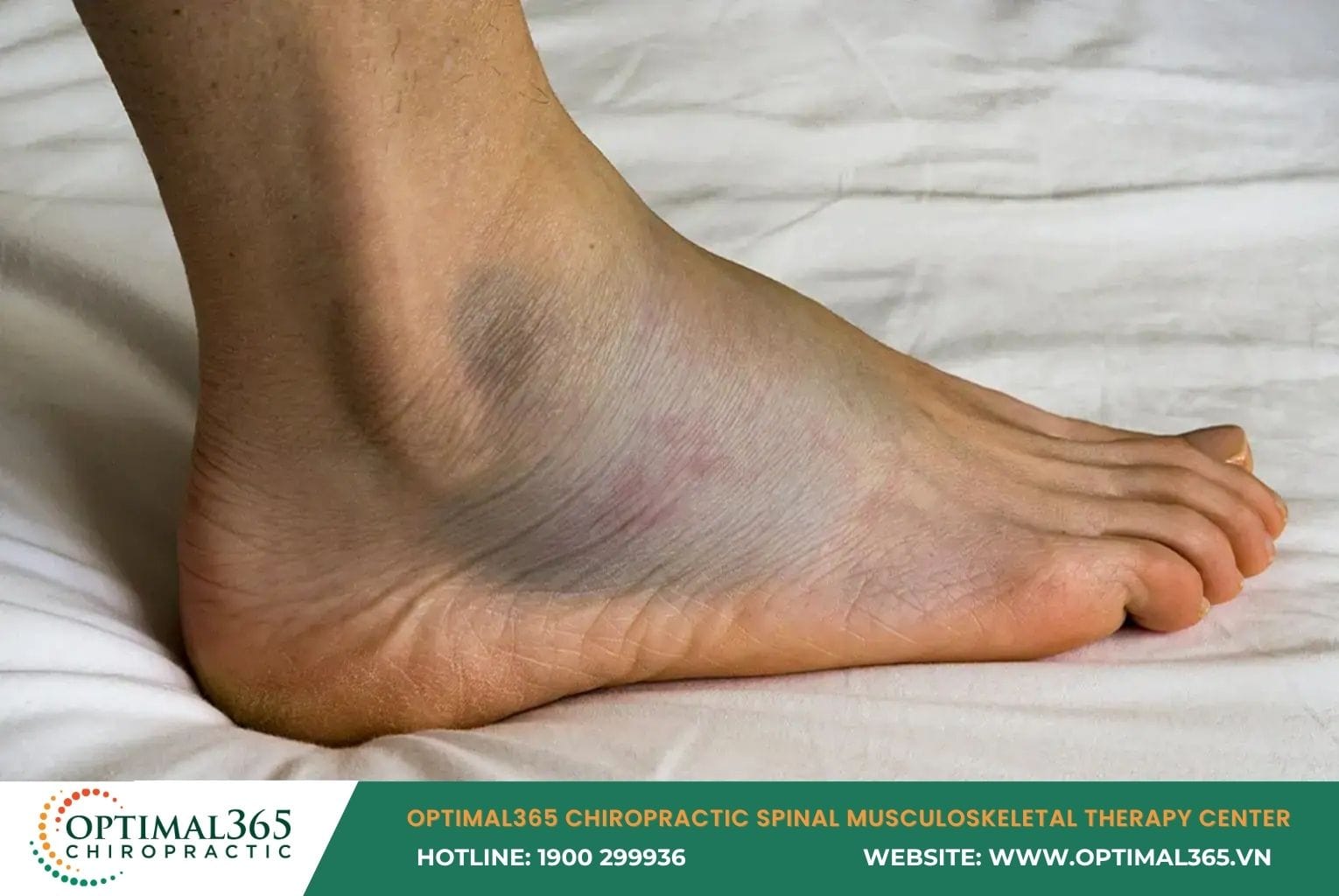 Degrees of Ankle Sprain