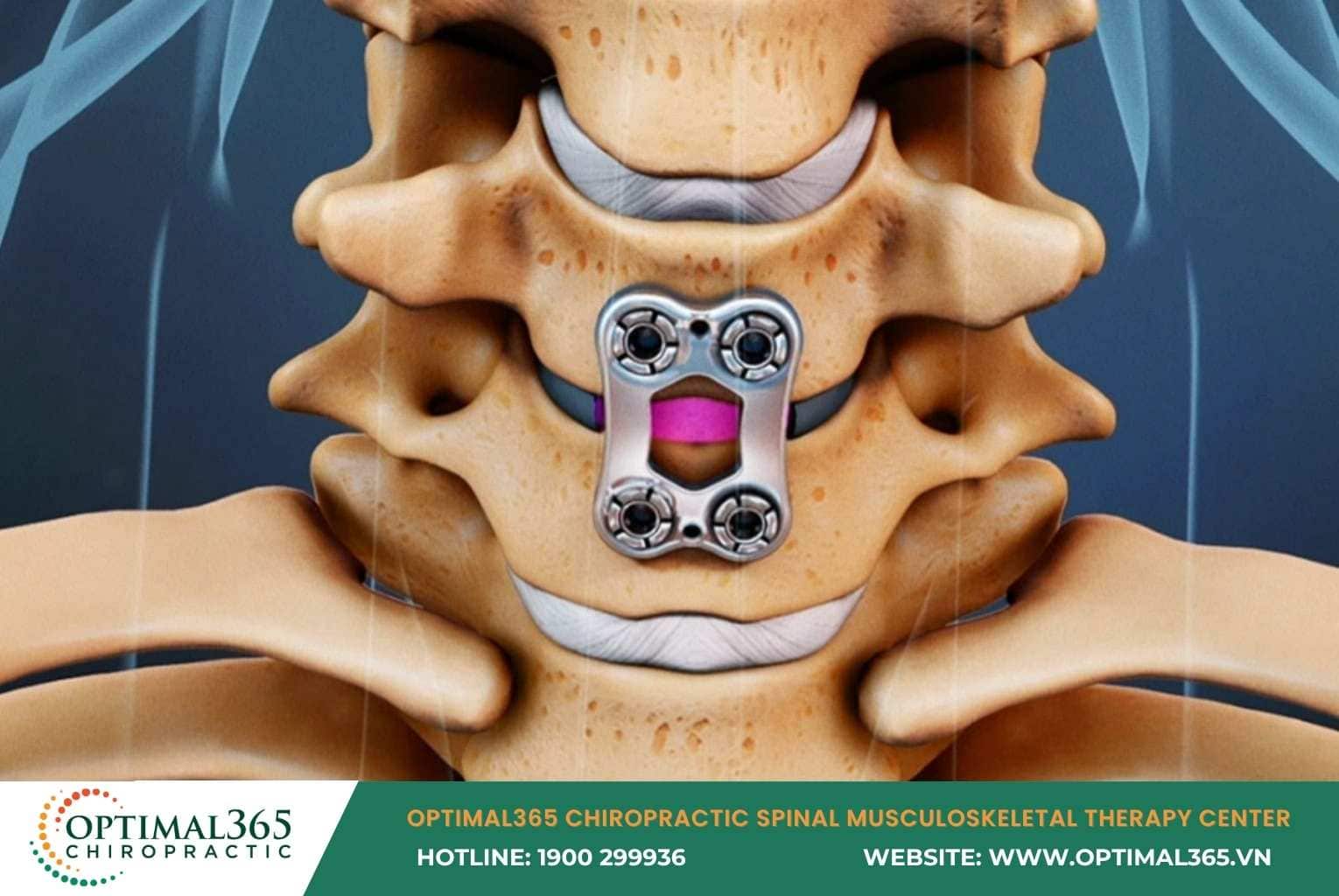 Cervical Herniated Disc