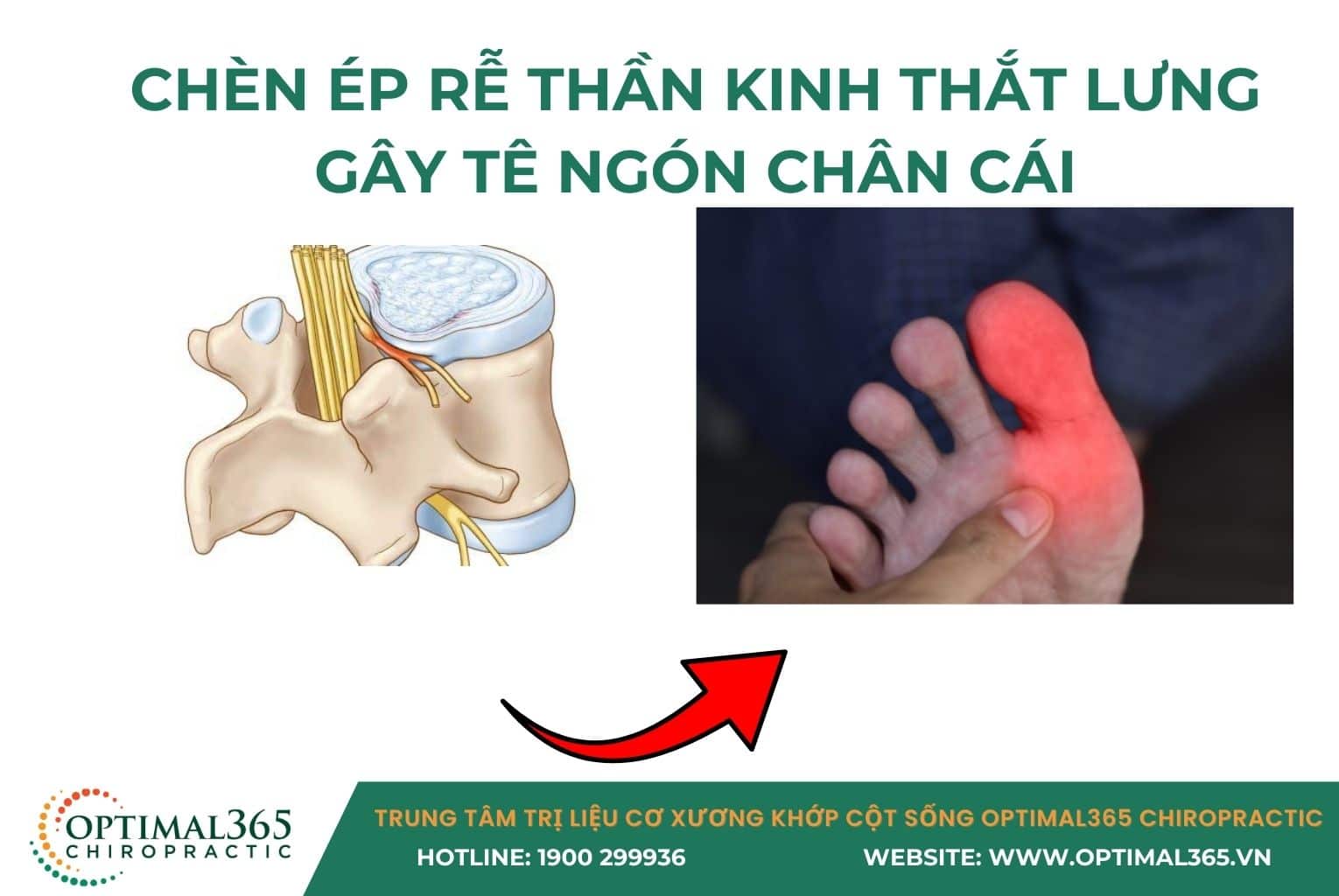 Chèn ép rễ thần kinh thắt lưng gây tê ngón chân cái