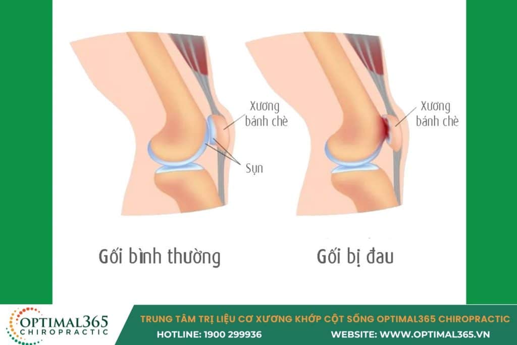 đau đầu gối ở người trẻ