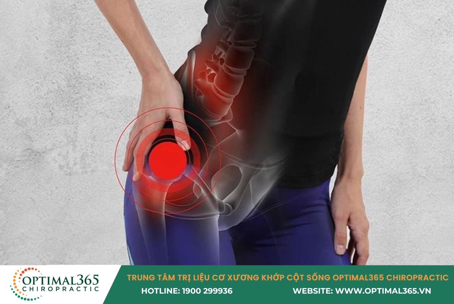 Yếu cơ mông và cơ vùng háng gây hội chứng dải chậu chày