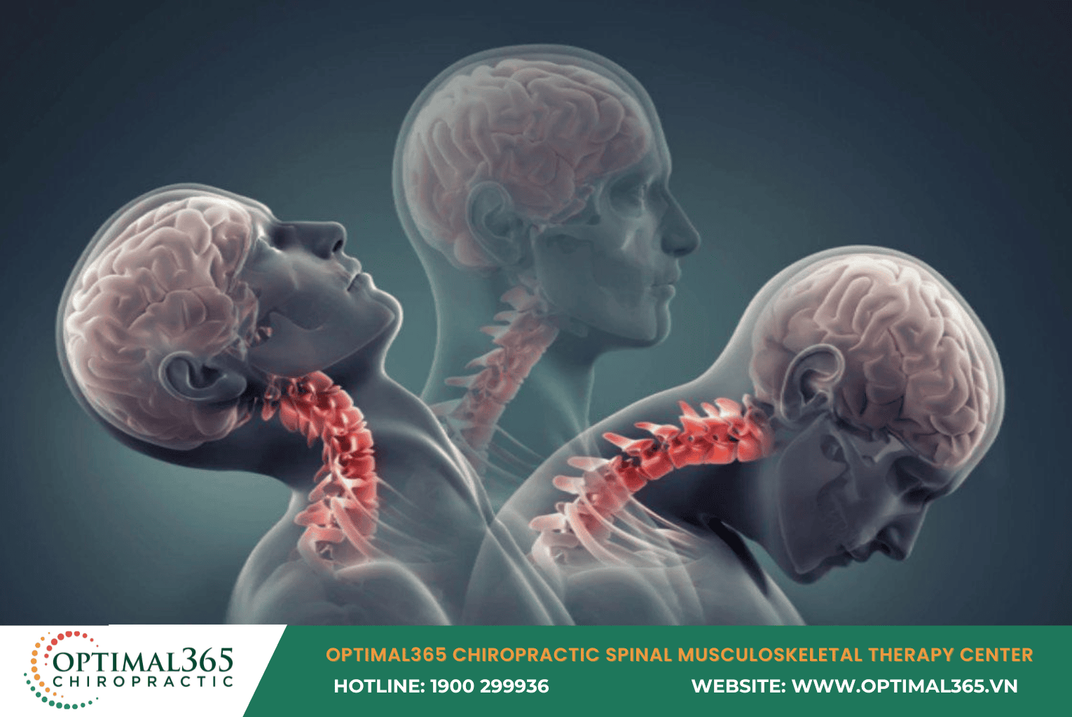 Cervical Spondylosis