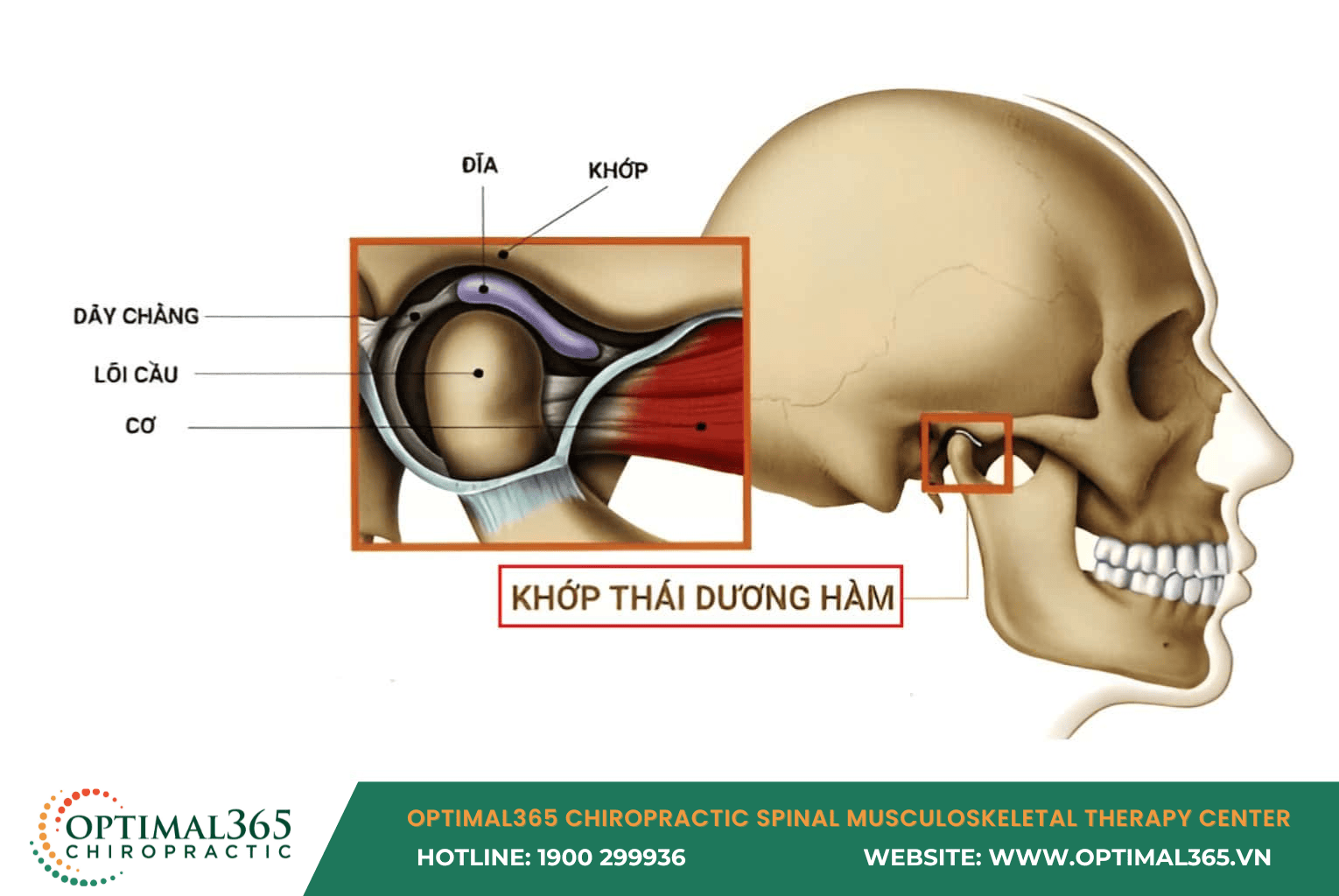 What is TMJ Disorder?