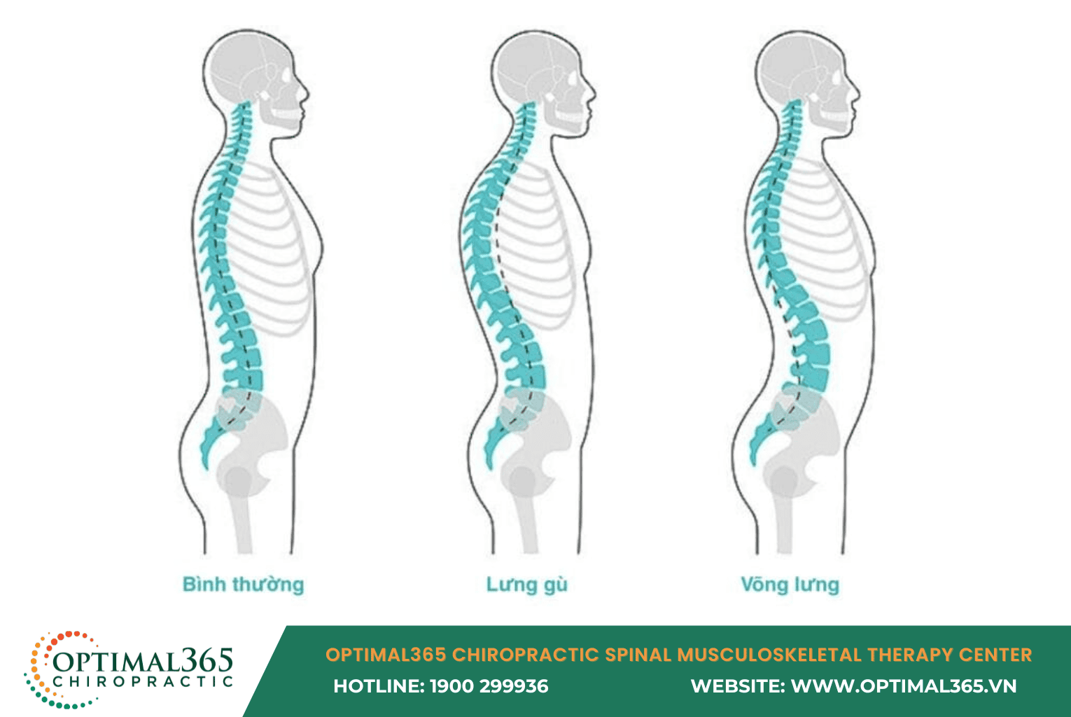 Signs You Have Anterior Pelvic Tilt