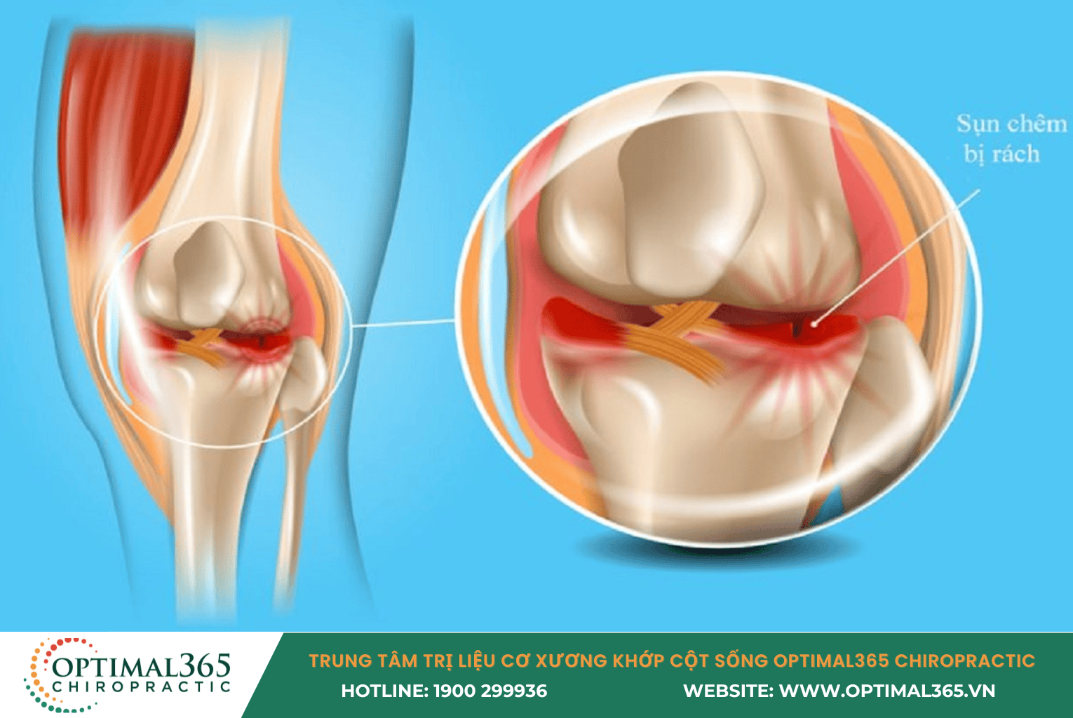 Rách sụn chêm đầu gối là gì ?