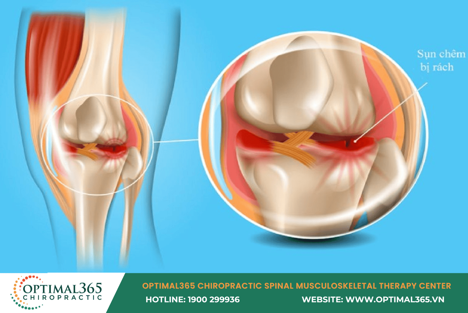 Meniscal Surgery